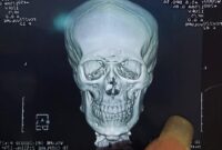 Foto : Hasil Ronsen yang diperlihatkan 