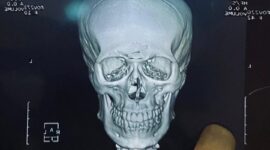 Foto : Hasil Ronsen yang diperlihatkan 