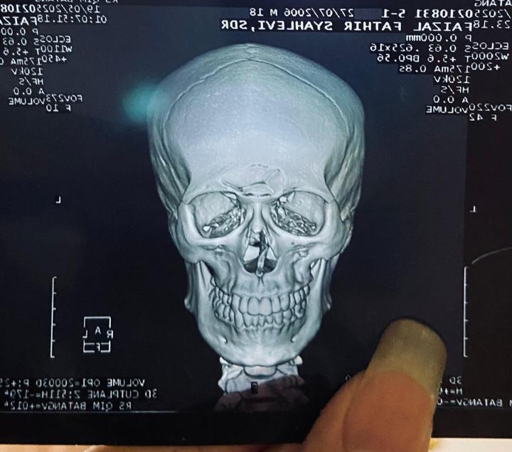 Foto : Hasil Ronsen yang diperlihatkan 